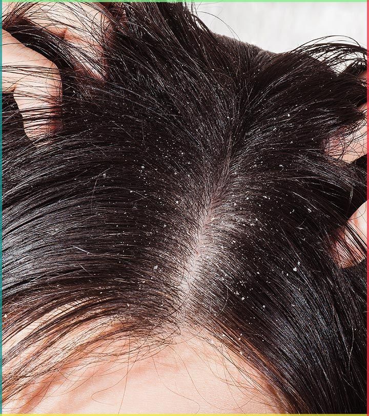 Close up photo of a woman scratching her scalp with white flakes