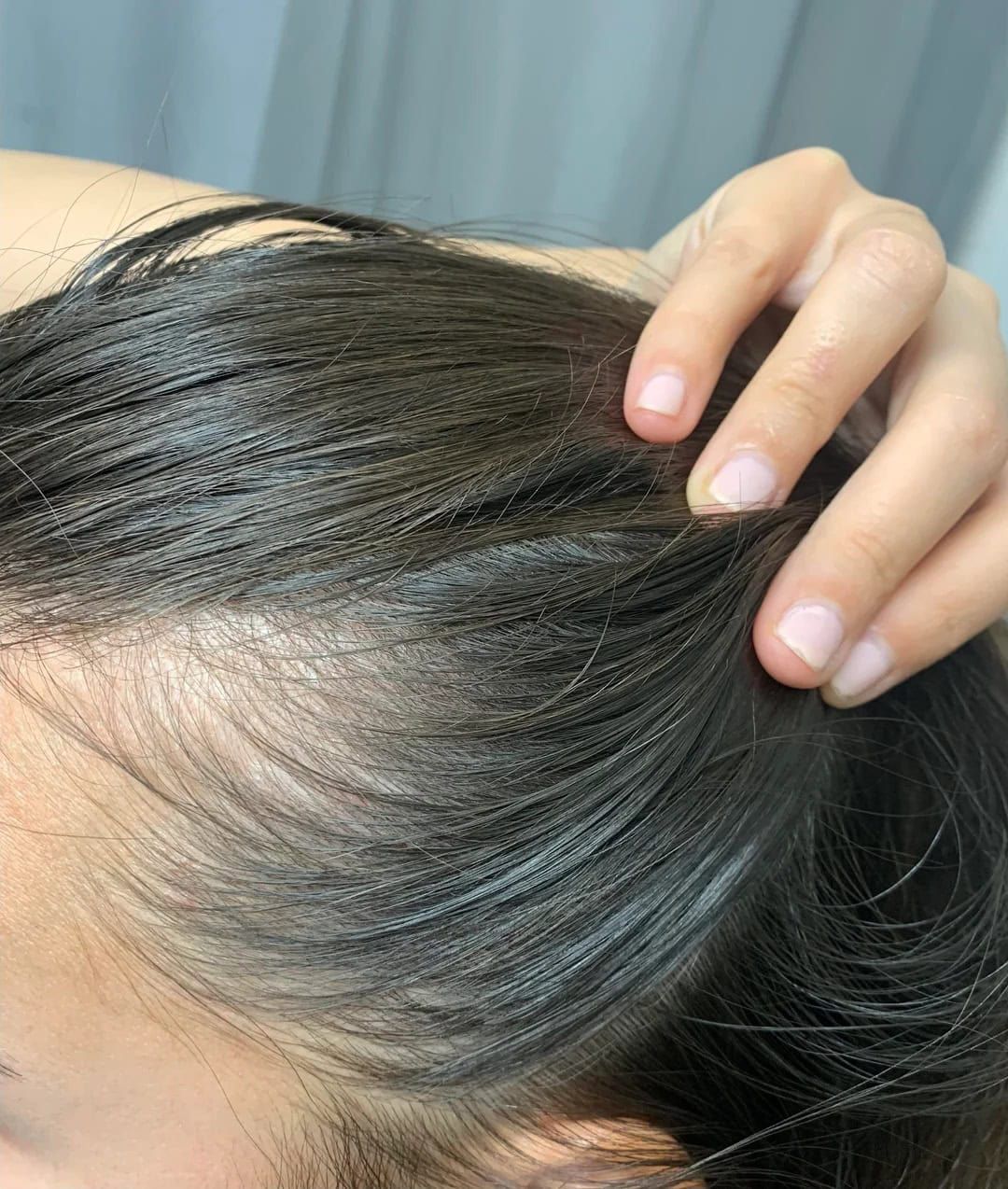 Does Vitamin Deficiency Cause Hair Loss?