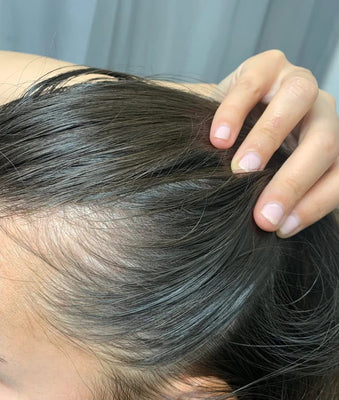 Does Vitamin Deficiency Cause Hair Loss?