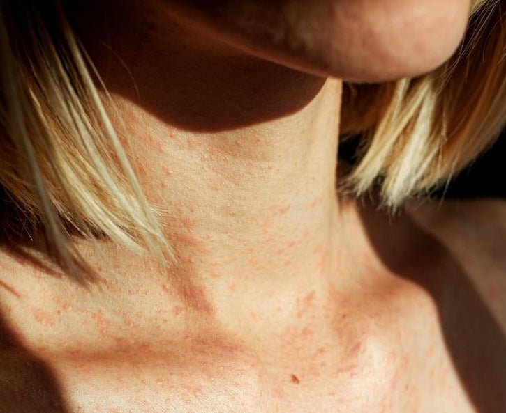 Image of woman's neck with eczema