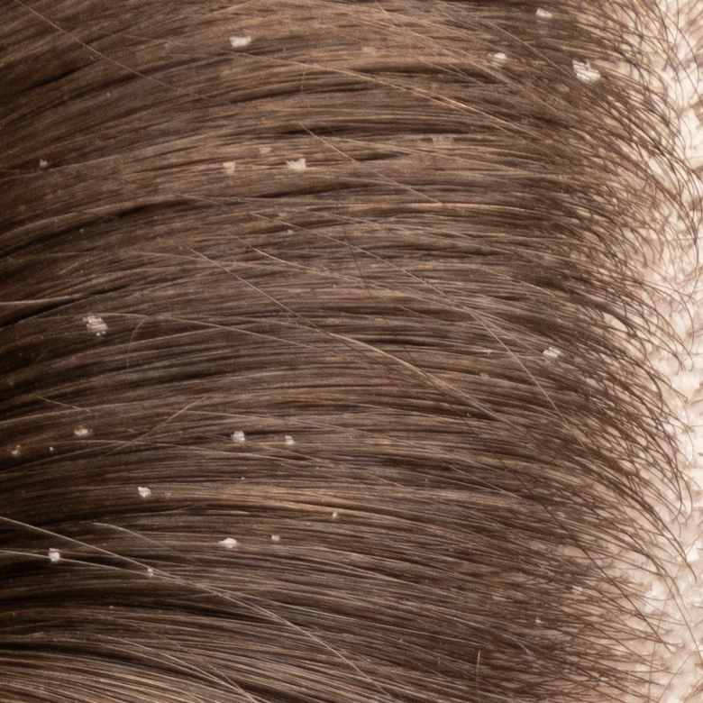 Dry Scalp Causes: 5 Causes You Should Know