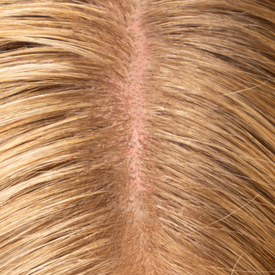 Atopic Dermatitis: Causes, Symptoms & Treatment