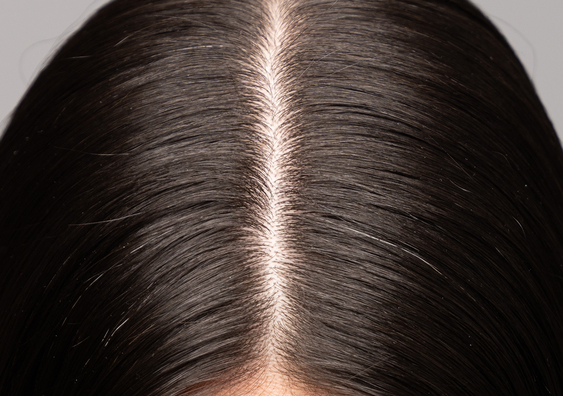 5 Types of Dandruff: Signs, Causes & Solutions