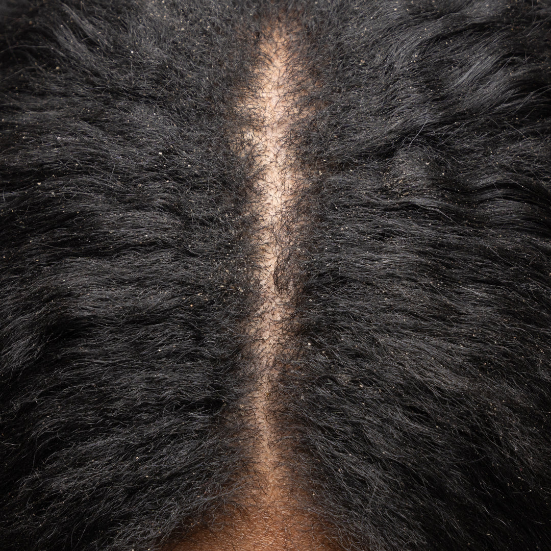 Should I Wash My Hair Every Day If I Have Dandruff?