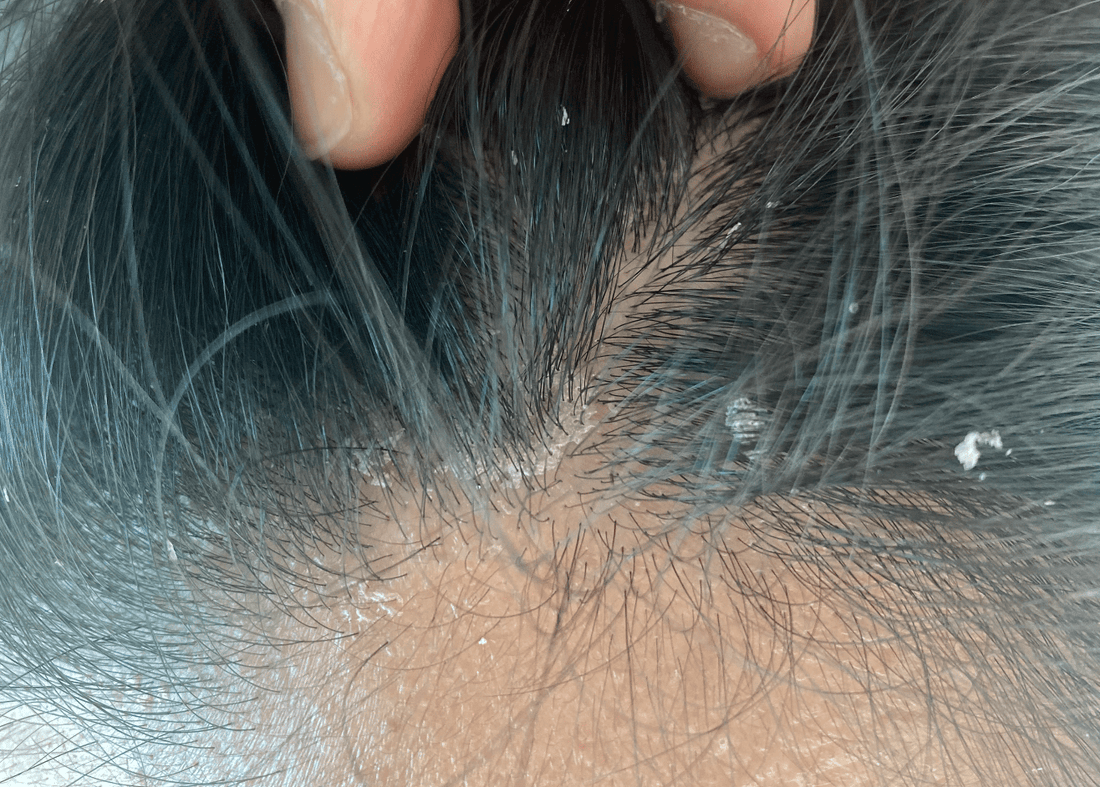 Photo of scalp with flaking due to Seborrheic Dermatitis