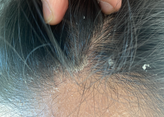 Seborrheic Dermatitis: Causes, Symptoms & Treatment