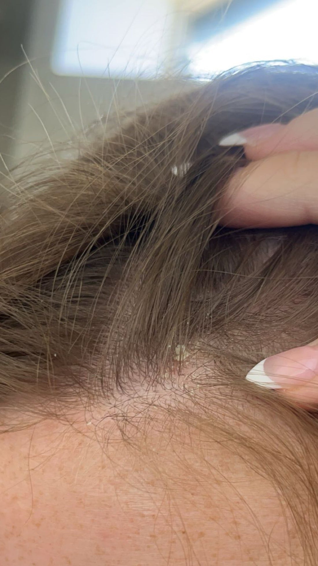 Seborrheic Dermatitis: Causes, Symptoms & Treatment
