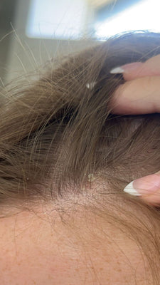 Seborrheic Dermatitis: Causes, Symptoms & Treatment